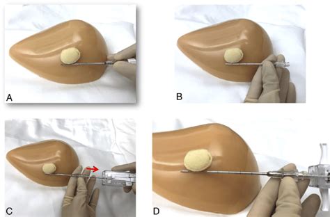 Spring-loaded core needle biopsy device open-trough technique (profile... | Download Scientific ...