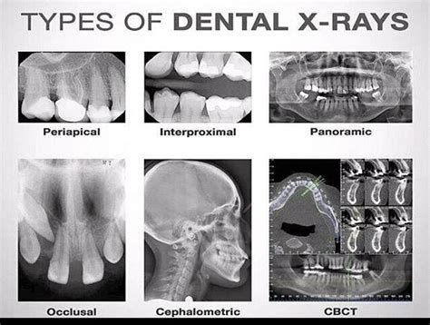 Periapical X Ray