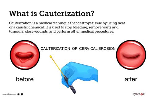 Cauterization: Causes, Symptoms, Treatment and Cost