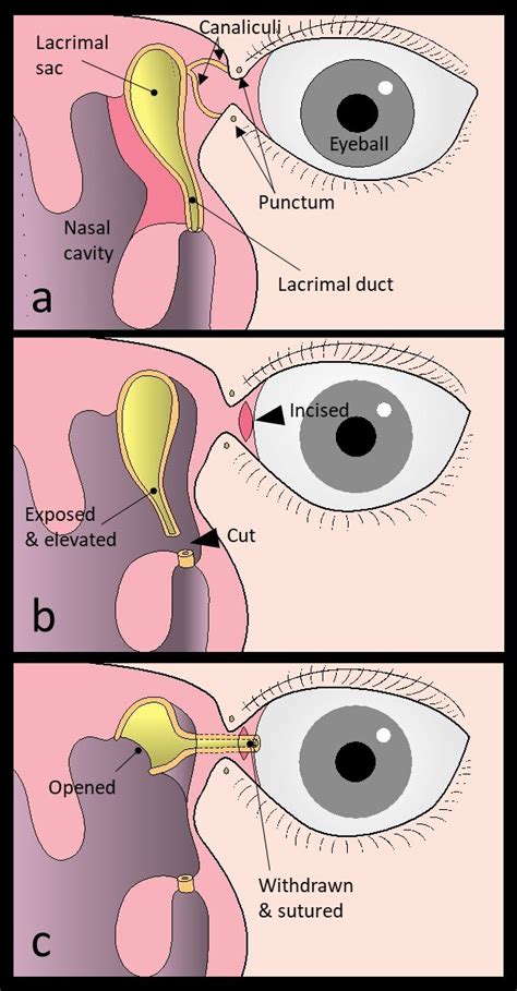 New surgical procedure developed to cure watery eyes