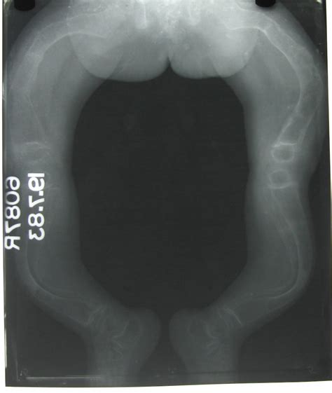 OSTEOGENESIS IMPERFECTA - Dr. Vasu