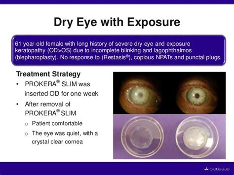 New Technologies for Successfully Managing Ocular Surface Inflammat…