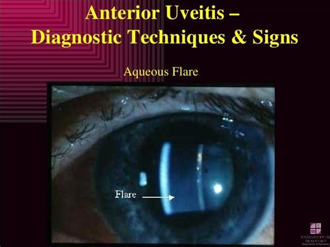 Anterior Uveitis