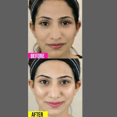 Skin Whitening Injections in Karachi - Cost, Benefits & Side Effects ...