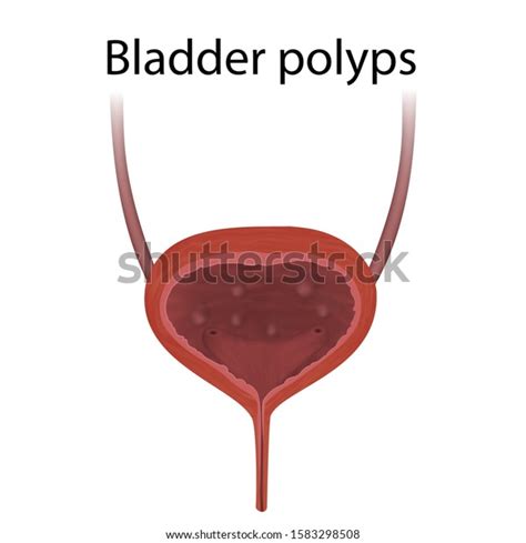 Bladder Polyps Abnormal Growth Tissue Medical Stock Illustration ...