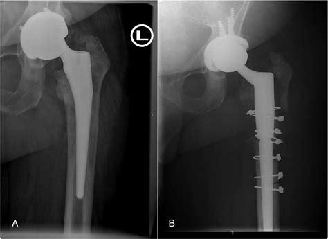 Catastrophic Failure of a Metal-on-Metal Total Hip Arthroplasty Secondary to Metal Inlay ...