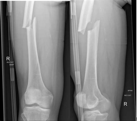 Atypical bilateral femoral fractures: a rare adverse effect of long-term bisphosphonate use ...