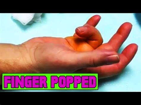 Popping Fingers! Dr. ER Pops Finger Into Place! - YouTube