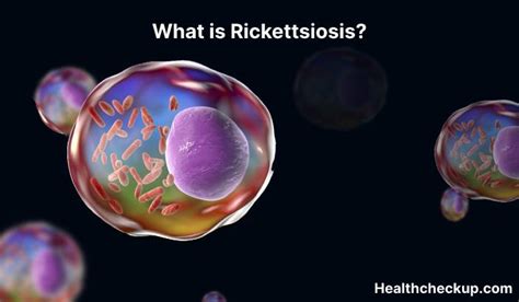 Rickettsiosis - Symptoms, Diagnosis, Treatment, Prevention