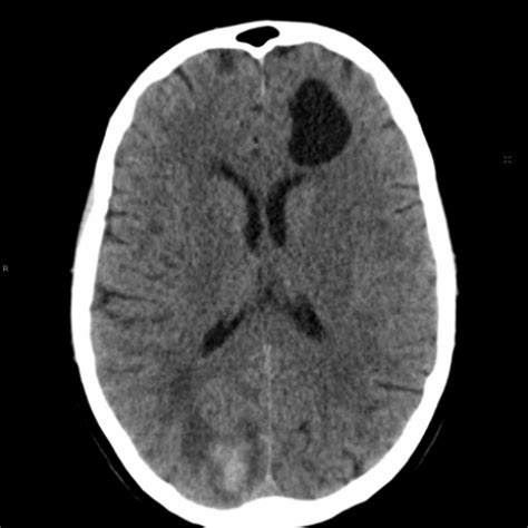 Neuroglial Cyst | Eurorad