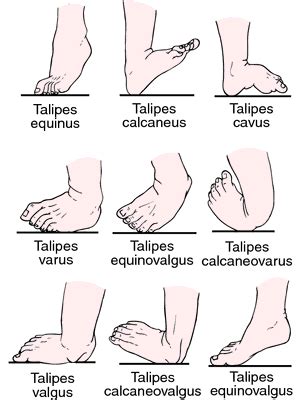 Talipes | definition of talipes by Medical dictionary