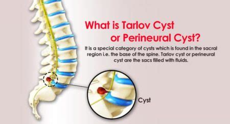 Tarlov Cyst Or Perineural Cyst | Learn All You Need to Know