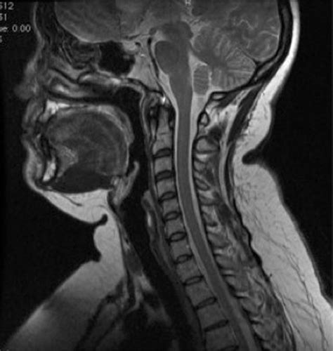 Cervical Spine Mri Abnormalities