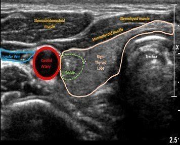 Normal Thyroid Ultrasound