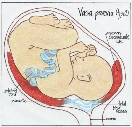 Vasa Previa VS Placenta Previa Symptoms, Management And Treatment