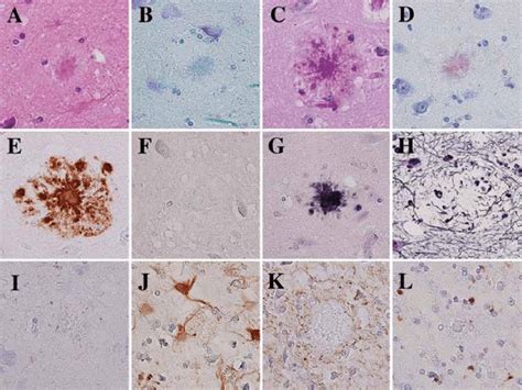 Kuru plaques by various staining methods. Amyloid deposits with... | Download Scientific Diagram