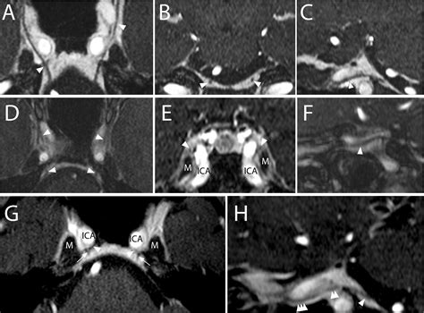 Detailed imaging of abducens nerve anatomy using contrast-enhanced 3D ...