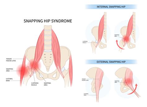 Exercises for Snapping Hip Syndrome - [P]rehab