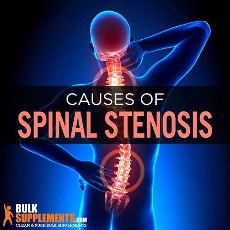 Spinal Stenosis Causes, Symptoms & Treatment by James Denlinger