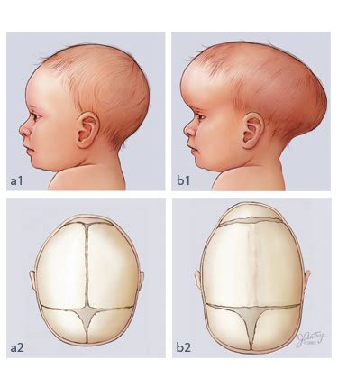 Dr. Arun L.Naik - Craniosynostosis