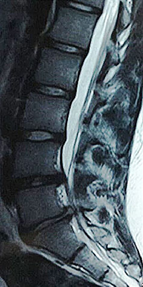 T2-weighted sagittal MRI image, disc herniation in L4-L5 and L5-S1. | Download Scientific Diagram