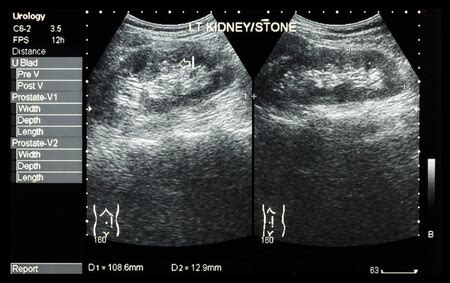 Segmentation and Tracking of Kidney Stones in Ultrasound Images