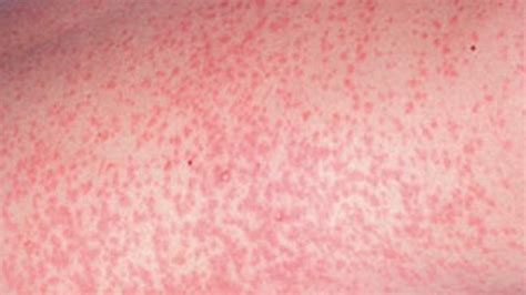 German Measles (Rubella): Causes, Symptoms, and Treatments