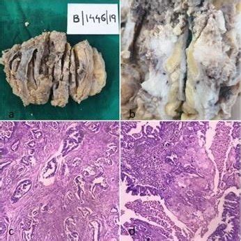 Gross specimen of Modified Radical mastectomy showing (a): Growth ...