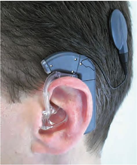 Cochlear Implant Cochlear Implant Online Cochlear Implant Cochlear ...