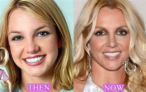 Britney Spears Before and After Plastic Surgery Reveals Her Popstar Journey