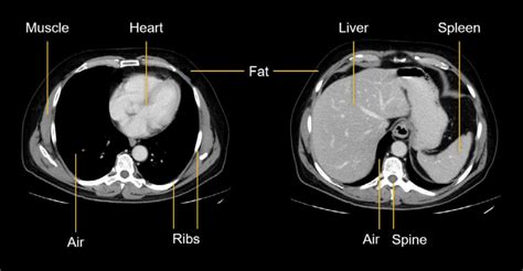 Abdominal CT: Basics • LITFL • Radiology library