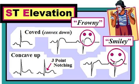 ECG Interpretation: ECG Interpretation Review #47 (Normal Variants - Early Repolarization ...