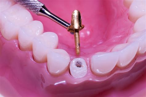 Ferrule effect improved outcomes in endodontically treated teeth? - National Elf Service