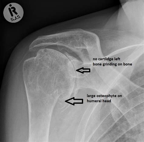 Osteoarthritis X Ray Shoulder