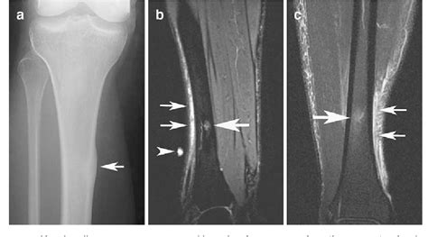 Tibial Stress Fracture Mri