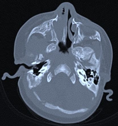 Nasal Blockage in Children -Choanal Atresia | Dr Paulose