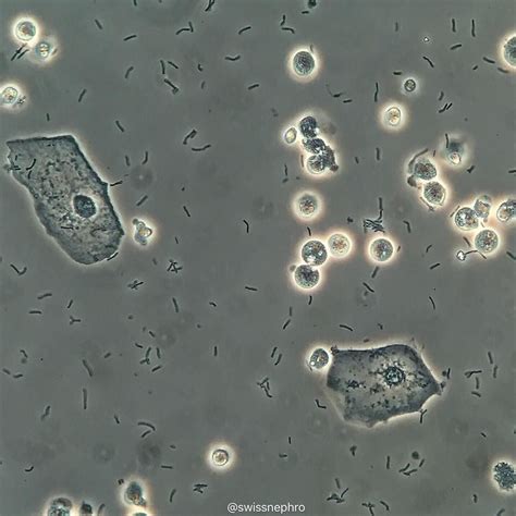 Epithelial Cells In Urine Microscopy