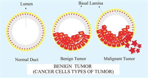 Benign tumor is one which is(A)Showing metastasis(B)Differentiated and capsulated(C ...