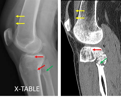 Tibial Plateau Fracture Icd 10 - Asking List