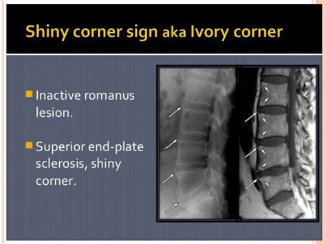 Seronegative spondyloarthropathies