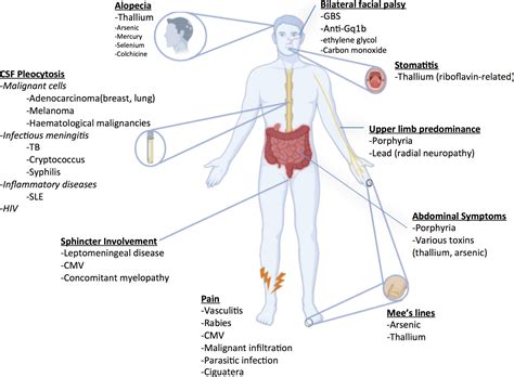 Altered mental status in “Guillain‐Barré syndrome” –a noteworthy clinical clue - Mulroy - 2020 ...