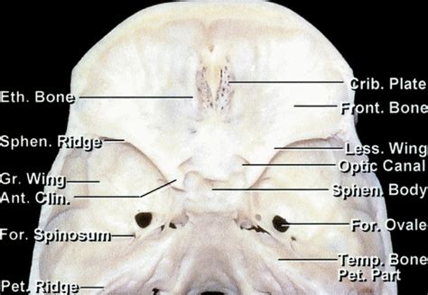 Medial Sphenoid Wing Meningioma | The Neurosurgical Atlas, by Aaron Cohen-Gadol, M.D.