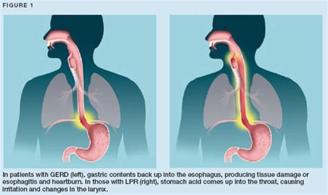 Laryngopharynx Reflux