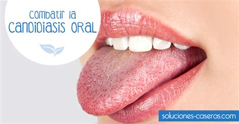 La candidiasis oral es una infección que afecta a la boca y que causa erupciones y picor. ¿Cómo ...