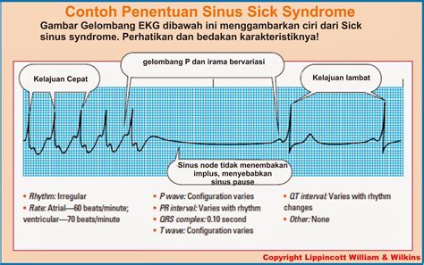 Sick Sinus Syndrome Causes Symptoms Treatment Sick Sinus Syndrome ...