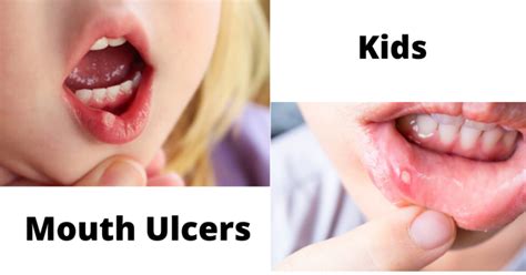 how to get rid of mouth ulcers in toddlers Archives - Dental Care Tips