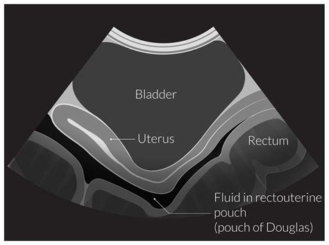 Vesicouterine Pouch Ultrasound