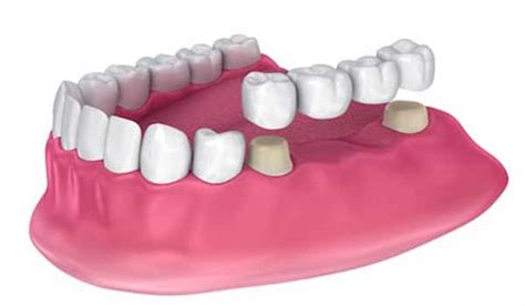 A Bridge Can Replace A Lost Tooth | Southridge Dental Group