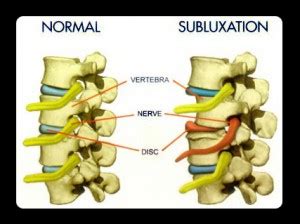 What is a subluxation? Correct Partial Dislocation