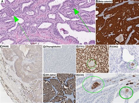 Cribriform-morular thyroid carcinoma. Tumor displays complex cribriform... | Download Scientific ...